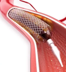 The-difference-between-angioplasty-and-angiography-and-angiogram